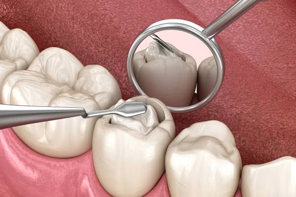 Tooth procedure model, illustrative dental-care visual